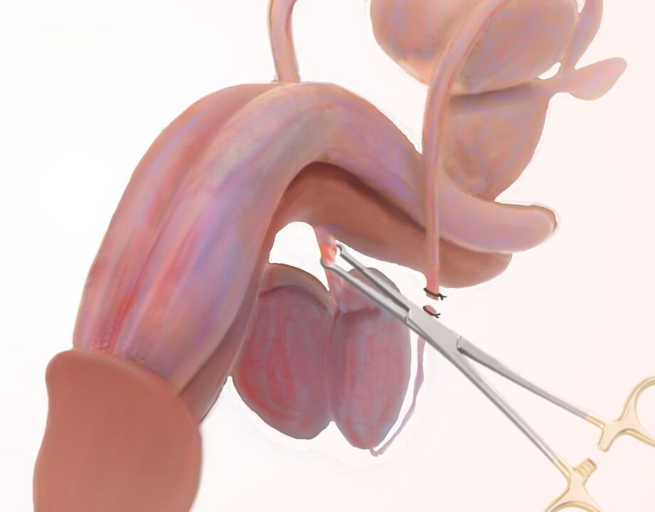 Ligamentotomía para agrandamento do pene